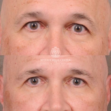 Beverly Hills Center Female Patient Before and After AuraLyft, Temporal Brow Reset, Blepharoplasty, CUPID LIFT® Corner Lift