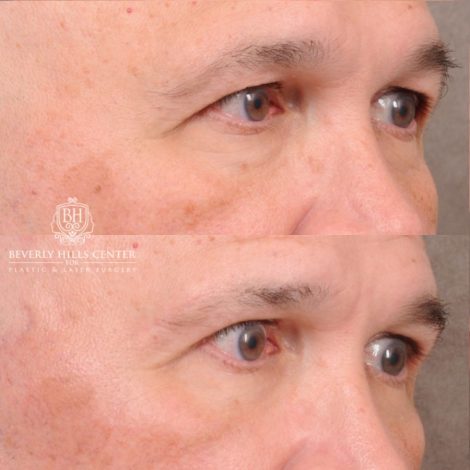 Beverly Hills Center Female Patient Before and After AuraLyft, Temporal Brow Reset, Blepharoplasty, CUPID LIFT® Corner Lift