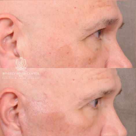 Beverly Hills Center Female Patient Before and After AuraLyft, Temporal Brow Reset, Blepharoplasty, CUPID LIFT® Corner Lift