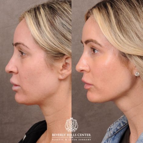 Beverly Hills Center Female Patient Before and After Weekend Necklift, Upper & Lower Blepharoplasty