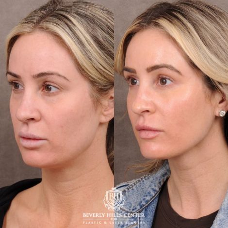 Beverly Hills Center Female Patient Before and After Weekend Necklift, Upper & Lower Blepharoplasty