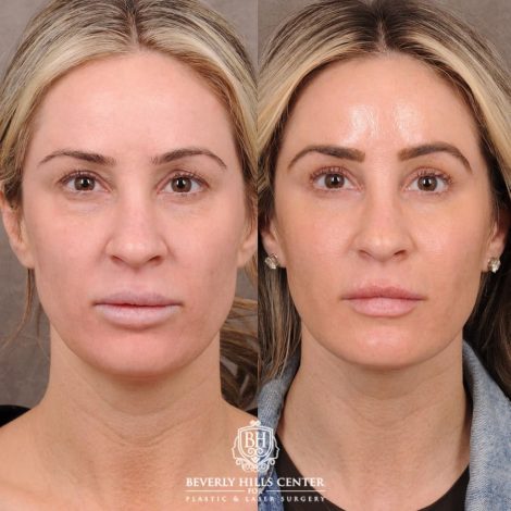Beverly Hills Center Female Patient Before and After Weekend Necklift, Upper & Lower Blepharoplasty