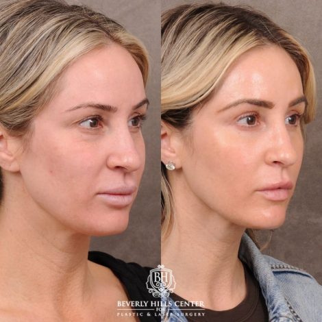 Beverly Hills Center Female Patient Before and After Weekend Necklift, Upper & Lower Blepharoplasty