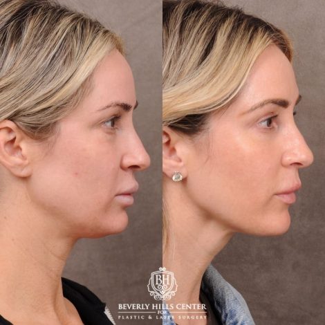 Beverly Hills Center Female Patient Before and After Weekend Necklift, Upper & Lower Blepharoplasty