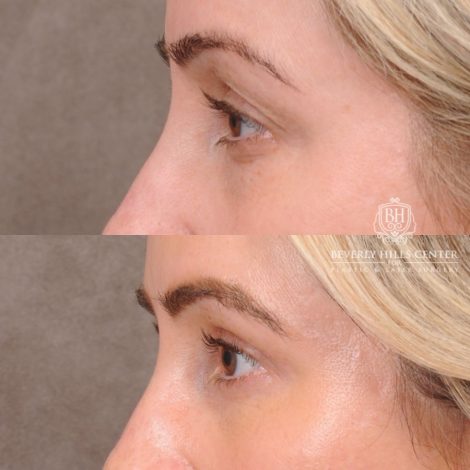 Beverly Hills Center Female Patient Before and After Weekend Necklift, Upper & Lower Blepharoplasty