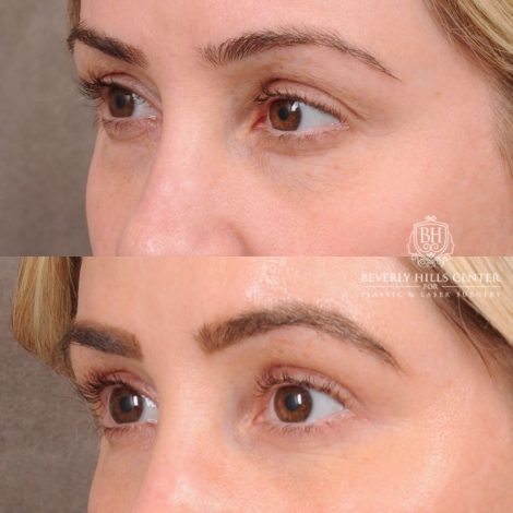 Beverly Hills Center Female Patient Before and After Weekend Necklift, Upper & Lower Blepharoplasty