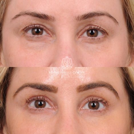 Beverly Hills Center Female Patient Before and After Weekend Necklift, Upper & Lower Blepharoplasty
