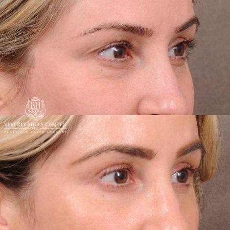 Beverly Hills Center Female Patient Before and After Weekend Necklift, Upper & Lower Blepharoplasty