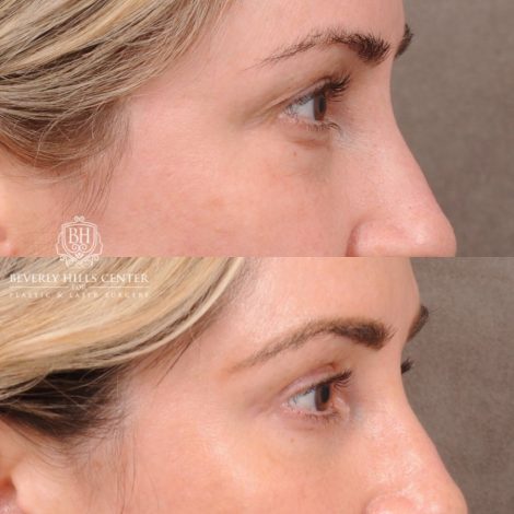 Beverly Hills Center Female Patient Before and After Weekend Necklift, Upper & Lower Blepharoplasty