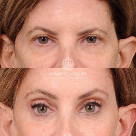 Beverly Hills Center Female Patient Before and After Upper Blepharoplasty