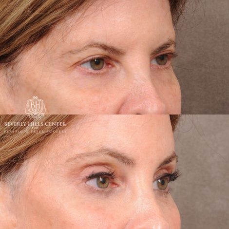 Beverly Hills Center Female Patient Before and After Upper Blepharoplasty