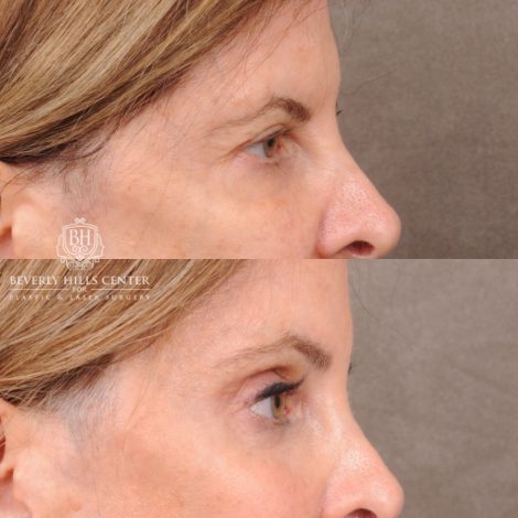 Beverly Hills Center Female Patient Before and After Upper Blepharoplasty