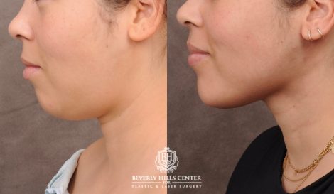 Beverly Hills Center Female Patient Before and After Weekend Necklift with Chin Implant