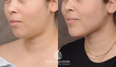 Beverly Hills Center Female Patient Before and After Weekend Necklift with Chin Implant