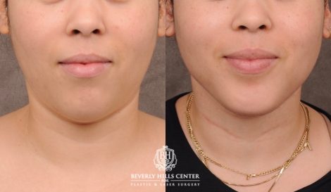 Beverly Hills Center Female Patient Before and After Weekend Necklift with Chin Implant