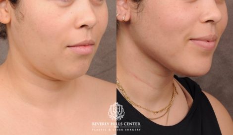 Beverly Hills Center Female Patient Before and After Weekend Necklift with Chin Implant