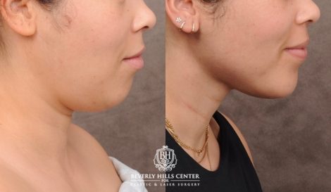 Beverly Hills Center Female Patient Before and After Weekend Necklift with Chin Implant