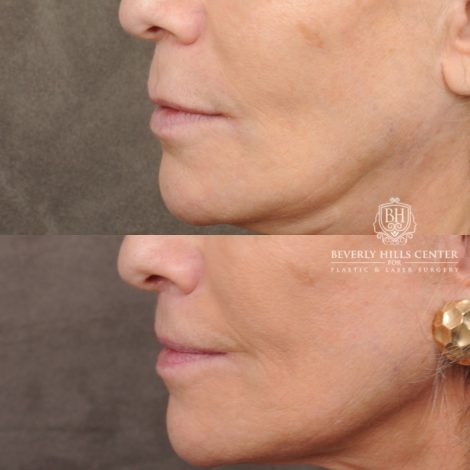 Beverly Hills Center Female Patient Before and After CUPID LIFT® Lip Lift