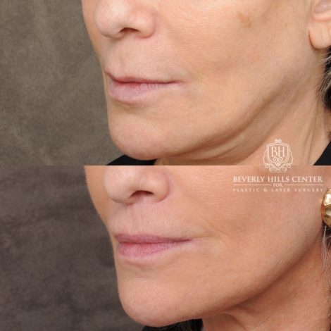 Beverly Hills Center Female Patient Before and After CUPID LIFT® Lip Lift