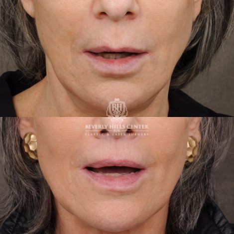 Beverly Hills Center Female Patient Before and After CUPID LIFT® Lip Lift