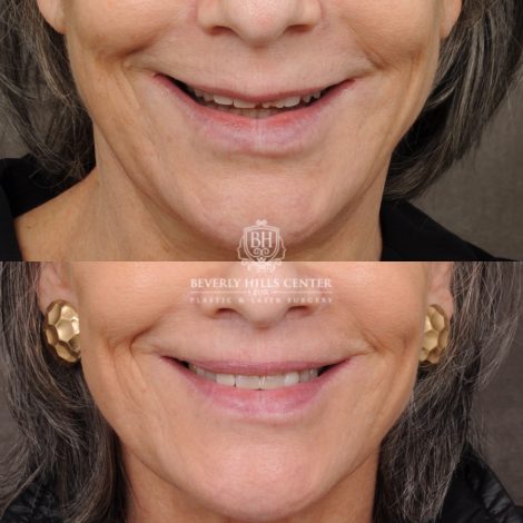 Beverly Hills Center Female Patient Before and After CUPID LIFT® Lip Lift