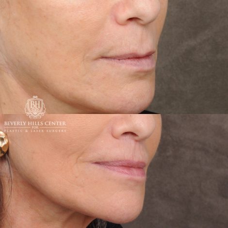 Beverly Hills Center Female Patient Before and After CUPID LIFT® Lip Lift