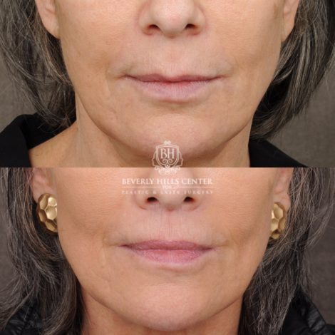 Beverly Hills Center Female Patient Before and After CUPID LIFT® Lip Lift