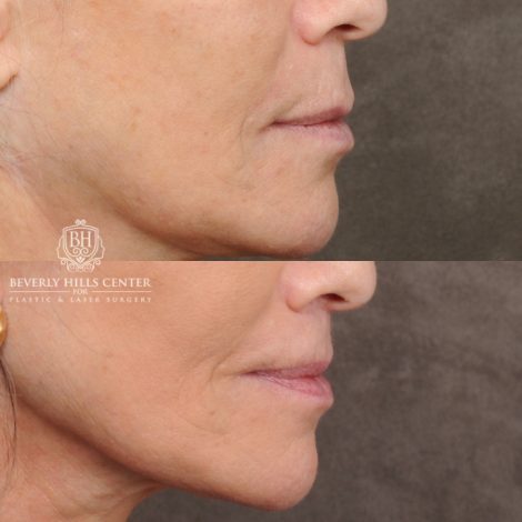 Beverly Hills Center Female Patient Before and After CUPID LIFT® Lip Lift