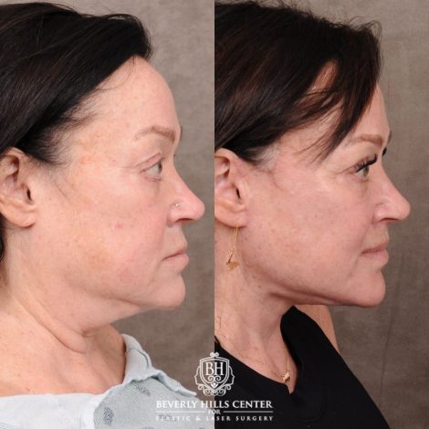 Beverly Hills Center Female Patient Before and After AuraLyft, CUPID LIFT®, Temporal Brow Reset, Upper Blepharoplasty & Fat Grafting