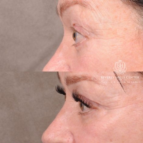 Beverly Hills Center Female Patient Before and After AuraLyft, CUPID LIFT®, Temporal Brow Reset, Upper Blepharoplasty & Fat Grafting