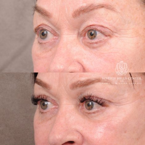 Beverly Hills Center Female Patient Before and After AuraLyft, CUPID LIFT®, Temporal Brow Reset, Upper Blepharoplasty & Fat Grafting