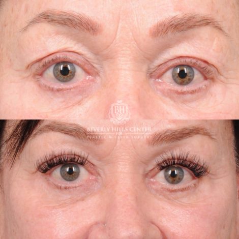 Beverly Hills Center Female Patient Before and After AuraLyft, CUPID LIFT®, Temporal Brow Reset, Upper Blepharoplasty & Fat Grafting