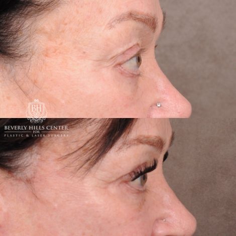 Beverly Hills Center Female Patient Before and After AuraLyft, CUPID LIFT®, Temporal Brow Reset, Upper Blepharoplasty & Fat Grafting