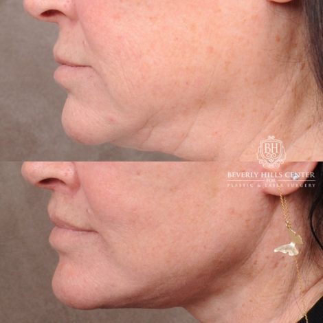 AuraLyft, CUPID LIFT® Lip Lift, Temporal Brow Reset, Upper Blepharoplasty & Fat Grafting