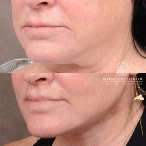 AuraLyft, CUPID LIFT® Lip Lift, Temporal Brow Reset, Upper Blepharoplasty & Fat Grafting