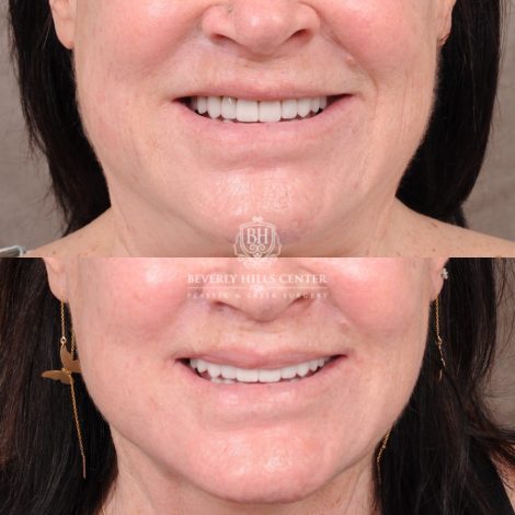 AuraLyft, CUPID LIFT® Lip Lift, Temporal Brow Reset, Upper Blepharoplasty & Fat Grafting