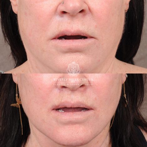 AuraLyft, CUPID LIFT® Lip Lift, Temporal Brow Reset, Upper Blepharoplasty & Fat Grafting