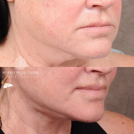 AuraLyft, CUPID LIFT® Lip Lift, Temporal Brow Reset, Upper Blepharoplasty & Fat Grafting