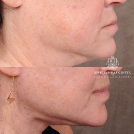 AuraLyft, CUPID LIFT® Lip Lift, Temporal Brow Reset, Upper Blepharoplasty & Fat Grafting