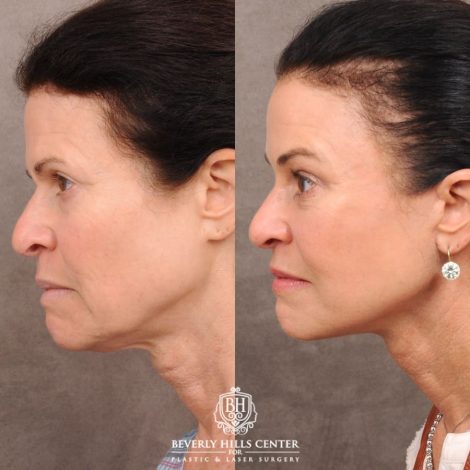 Beverly Hills Center Female Patient Before and After AuraLyft™, Lower Blepharoplasty, Temporal Brow Reset, and PHAT Face Treatment