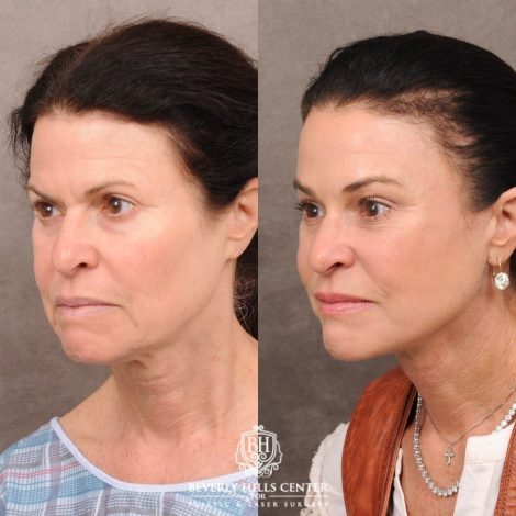 Beverly Hills Center Female Patient Before and After AuraLyft™, Lower Blepharoplasty, Temporal Brow Reset, and PHAT Face Treatment
