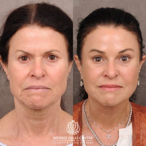 Beverly Hills Center Female Patient Before and After AuraLyft™, Lower Blepharoplasty, Temporal Brow Reset, and PHAT Face Treatment