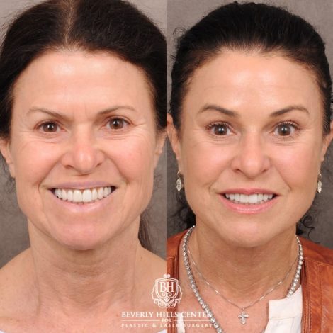 Beverly Hills Center Female Patient Before and After AuraLyft™, Lower Blepharoplasty, Temporal Brow Reset, and PHAT Face Treatment