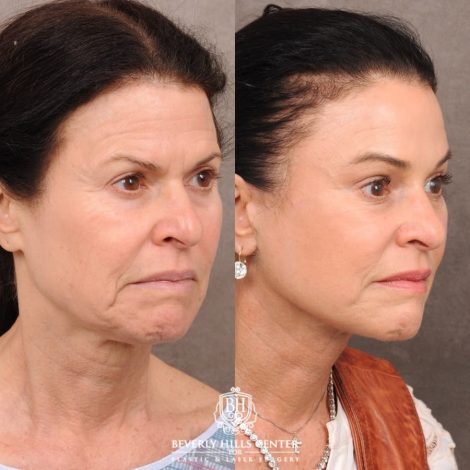 Beverly Hills Center Female Patient Before and After AuraLyft™, Lower Blepharoplasty, Temporal Brow Reset, and PHAT Face Treatment