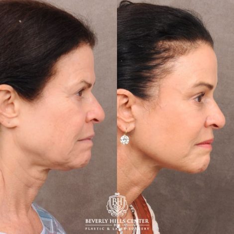 Beverly Hills Center Female Patient Before and After AuraLyft™, Lower Blepharoplasty, Temporal Brow Reset, and PHAT Face Treatment