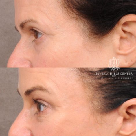 Beverly Hills Center Female Patient Before and After AuraLyft™, Lower Blepharoplasty, Temporal Brow Reset, and PHAT Face Treatment