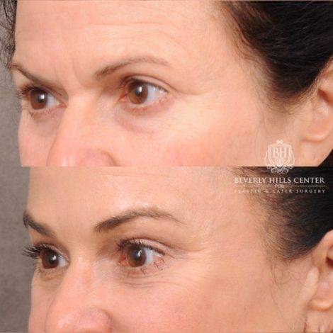 Beverly Hills Center Female Patient Before and After AuraLyft™, Lower Blepharoplasty, Temporal Brow Reset, and PHAT Face Treatment