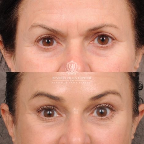 Beverly Hills Center Female Patient Before and After AuraLyft™, Lower Blepharoplasty, Temporal Brow Reset, and PHAT Face Treatment