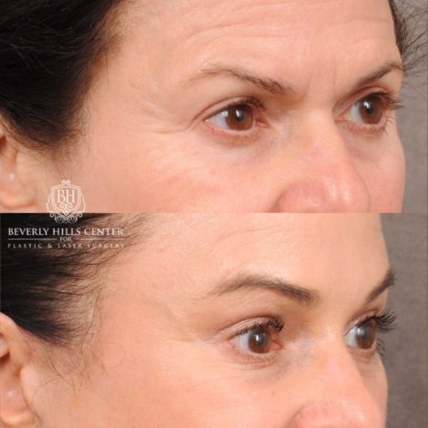 Beverly Hills Center Female Patient Before and After AuraLyft™, Lower Blepharoplasty, Temporal Brow Reset, and PHAT Face Treatment