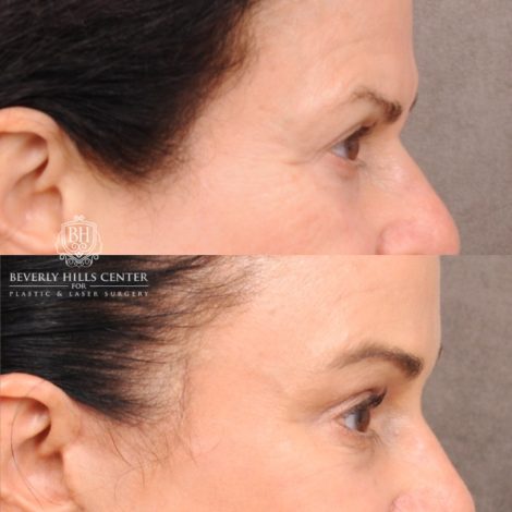 Beverly Hills Center Female Patient Before and After AuraLyft™, Lower Blepharoplasty, Temporal Brow Reset, and PHAT Face Treatment